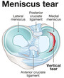 Meniscus tear anatomy. Labeled illustration