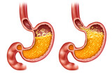 Fototapeta Panele - Acid Reflux And Heartburn or Gastroesophageal disease or GERD as an open sphincter with an iflamed esophagus as a medical symbol for regurgitation and a burning sensation in the chest.