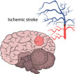 Vector illustration of ischemic stroke. Brain infarction.