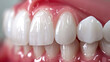 
Facetas de resina composta para correção do formato dos dentes, resultado altamente estético e natural