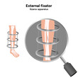 © Oksana - External fixator, llizarov apparatus zoom leg