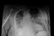 Chest X-ray: Respiratory infection and total destruction of the right humeral head. Medical themes