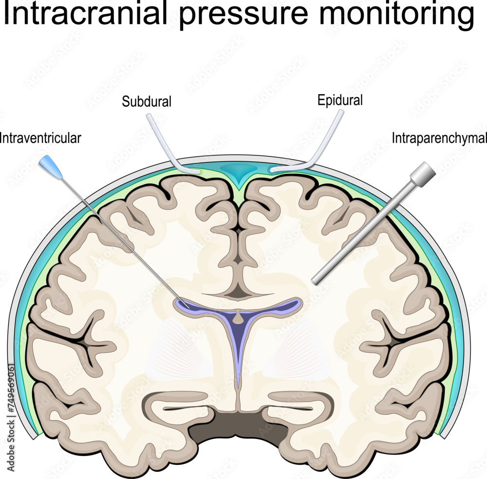 Intracranial pressure. ICP monitoring Stock Vector | Adobe Stock