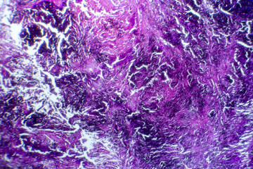 Photomicrograph of lung tissue with silicosis pathology under a microscope, revealing silica particle accumulation in alveoli and fibrosis.