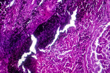 Poster - Photomicrograph of lung tissue with silicosis pathology under a microscope, revealing silica particle accumulation in alveoli and fibrosis.