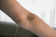 Bruising on the arm caused by blood donation or serum injection, woman holding her arm