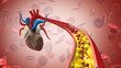 Cholesterol plaque in artery blocking blood flow