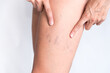 © Jezabel - small veins in legs. poor circulation, varicose veins