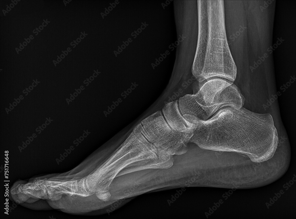 Diagnostic medicine, x-ray image of human foot Stock Photo | Adobe Stock