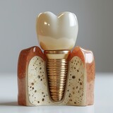 Fototapeta  - Dental implant with screw, abutment and crown