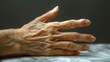 Joint pain in an Asian woman's hand due to gout in one finger