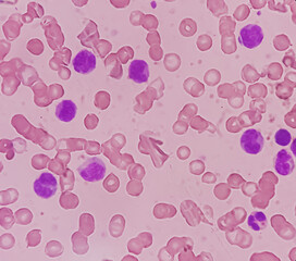 Canvas Print - Leukemia. Photomicrograph of hematological blood slide showing neutrophilic leukocytosis with monocytosis with occasional myelocytes seen. Chronic myelomonocytic leukemia. Thrombocytopenia.