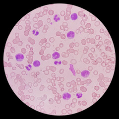 Poster - Leukemia. Photomicrograph of hematological blood slide showing neutrophilic leukocytosis with monocytosis with occasional myelocytes seen. Chronic myelomonocytic leukemia. Thrombocytopenia.