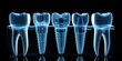 dental implant x ray 