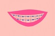 © Gemma can fly/Stocksy - Smiling mouth with orthodontics. Dentist concept