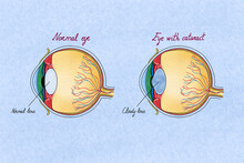 Human Normal Eye Vs A Eye With Cataracts. Illustration