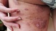 © Rung Kh - close up of a person with an injection, rash hives allergy and inflammation skin on the leg, problem circulation of blood, health and and medical concept.