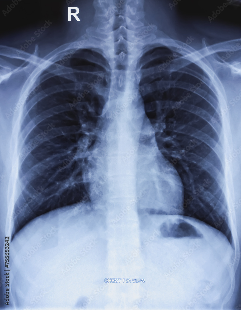 Chest xray PA view film. Normal chest radiograph. Stock Photo | Adobe Stock