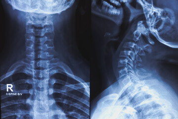 Naklejka na meble Photo of human neck X-ray image. X-ray of cervical spine ap and lateral view.