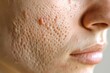 © Hanna Haradzetska - Macro photo of post-acne scars, showcasing the texture and unevenness of the skin