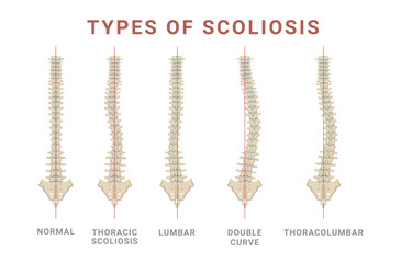 Wall Mural - Scoliosis types spine skeleton normal and disease structure with names vector flat illustration