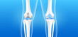 Total knee replacement or Partial implant for treatment relieve arthritis, after joint damaged. X Ray scan leg bone and cartilage. Medical health care science technology concept. 3D vector banner.