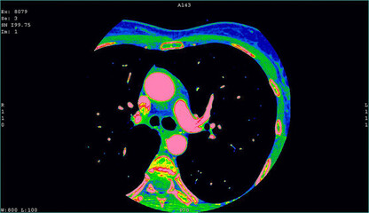 Angio CT cardiac scan. Computer tomography image of the heart