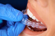 Close up of female patient getting dental aligner at orthodontist office.