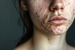 © Hanna Haradzetska - Photo close up of a young woman with cystic acne, highlighting painful and deep-seated pimples on the face.