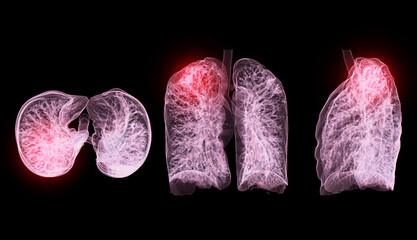 Wall Mural - A CT chest 3D scan displaying a lesion at the right upper lobe offers a detailed visualization, aiding in precise identification and  treatment planning.