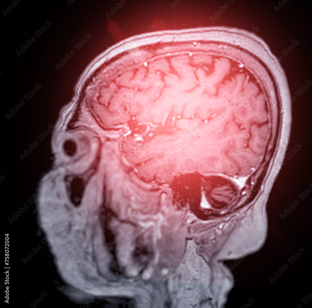 MRI brain scan sagittal plane for detect Brain diseases sush as stroke ...