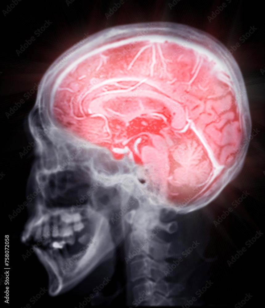 MRI brain scan sagittal plane for detect Brain diseases sush as stroke ...