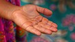 Authentic Images Depicting Girl's Hand Eczema Treatment Progress
