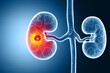 Medically accurate illustration of kidney cancer. showing presence of cancerous tumor inside the kidney. 3d illustration