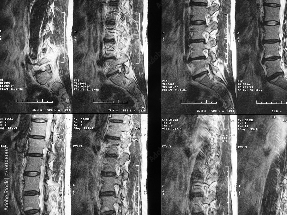 MRI scan of lumbar spine