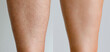Image before and after woman's Legs hairs removal, skin care treatment for smooth skin concept.