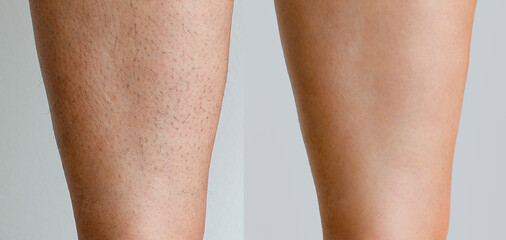 Image before and after woman's Legs hairs removal, skin care treatment for smooth skin concept.