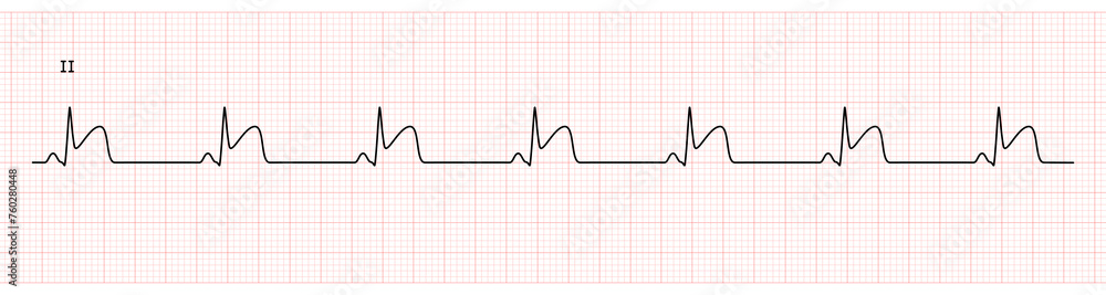 EKG Monitor in lead II Showing Sinus Rhythm with STEMI at Inferior Wall ...