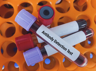 Sticker - Blood sample for Antibody detection test, diagnosis of hemolytic anemia or hemolytic disease. Indirect Coofmb's test.