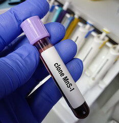 Canvas Print - Technician hold blood sample for Clone MnS1 blood test. Monoclonal Antibody test.