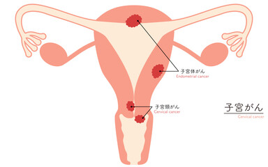 Wall Mural - 子宮がんの図解イラスト、子宮・卵巣の解剖図