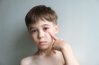 The boy points at his swollen eye from an insect bite. Close-up portrait of child with angioedema. Allergic response. Red inflamed upper eyelid. Inflammation. Itching bites concept. Quincke's edema