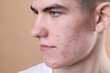 © New Africa - Young man with acne problem on beige background, closeup
