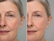 © New Africa - Aging skin changes. Collage with photos of mature woman before and after cosmetic procedure on grey background, closeup