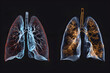 Creative comparative image featuring side-by-side MRI scans of healthy lungs and those of a habitual smoker, emphasizing the stark contrasts in tissue health, Lung disease. Smoker affected. PM 2.5 