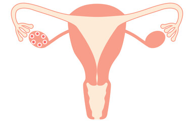 Diagrammatic illustration of polycystic ovary syndrome (ovulation disorder), anatomy of the uterus and ovaries