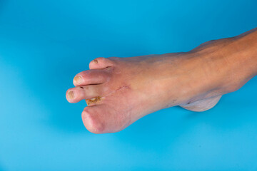 Amputation of diabetic toes of a person on a blue background. Selective focus.