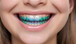 Smile of a teenage girl with bright multi-colored shiny braces on healthy white teeth created with generative ai.
