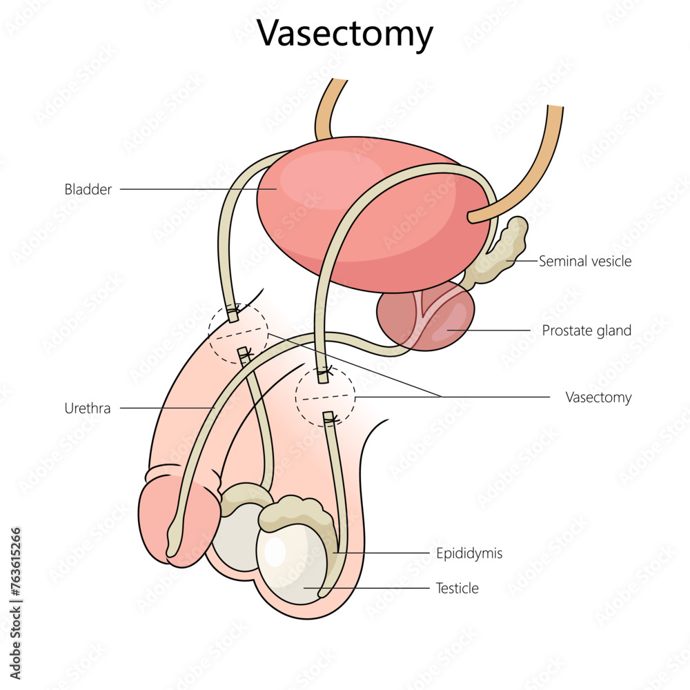 vasectomy on the male reproductive system, highlighting key anatomical ...