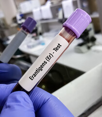 Canvas Print - Technician hold blood sample for Er Blood Group System.